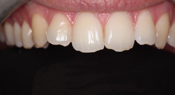 Composite Bonding case 7 before