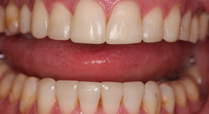 Smile Makeover Case 1 after