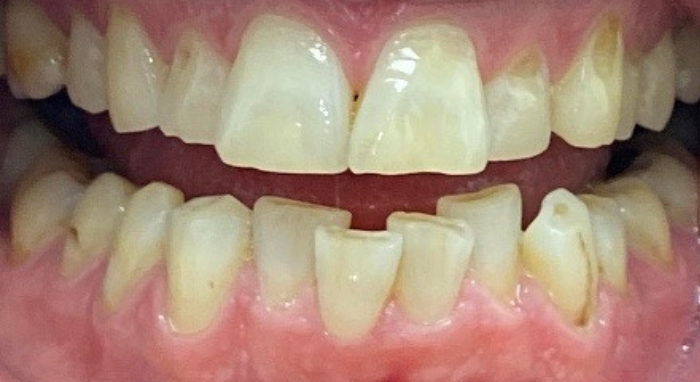 Smile Makeover Case 1 before