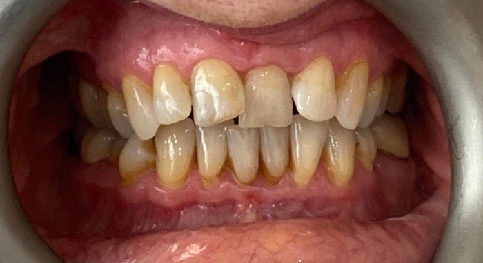 Smile Makeover Case 2 before