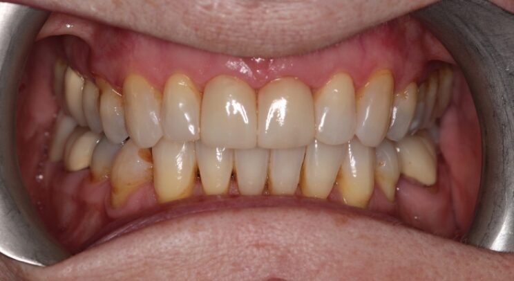 Smile Makeover Case 2 after