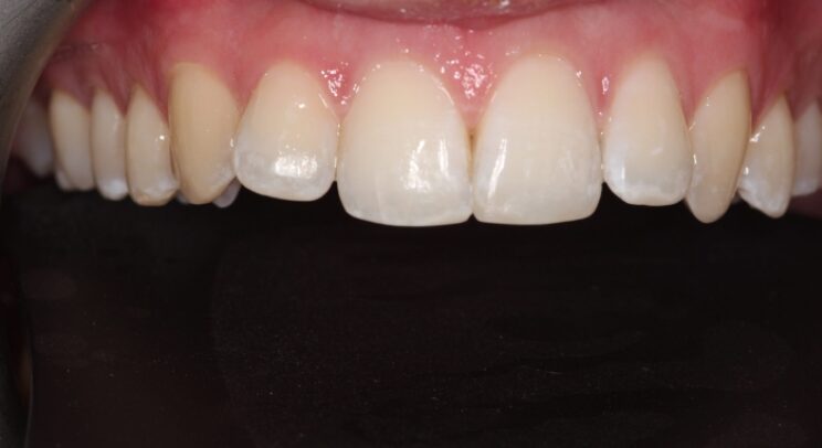 Composite Bonding case 7 after